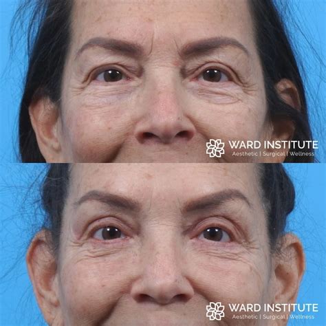 Blepharoplasty Plastic Surgery In Slc Ut Ward Institute