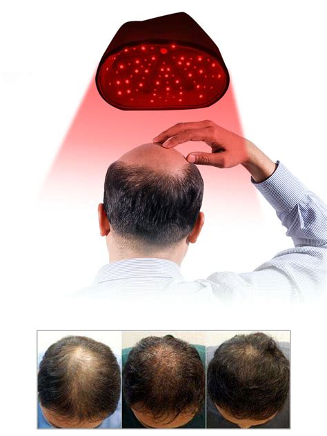 Does Red Light Therapy Hair Growth Work Shelly Lighting