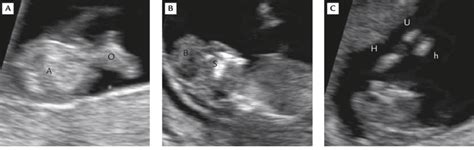 Prenatal ultrasound at 12 weeks' gestation shows: (A) omphalocele; (B ...