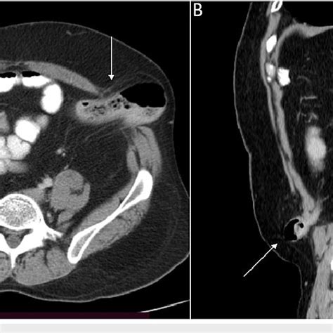 Contrast Enhanced Ct Images A Axial Image Showing The Herniating Download Scientific Diagram