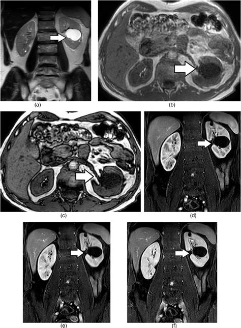 Figure From Cross Sectional Imaging Assessment Of Renal Masses With