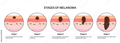 Melanoma stages poster Stock Vector | Adobe Stock