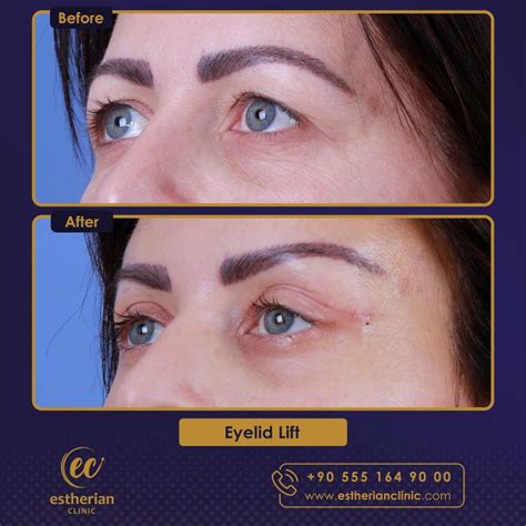 Eyebrow Lift – Estherian Clinic