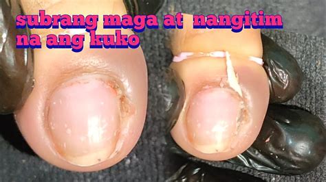 Namumula At Nangingitim Sa Subrang Maga Ang Kuko Firstm Ni Ate Na