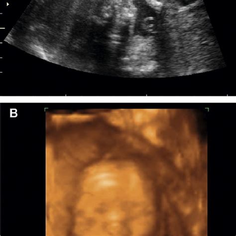 Pdf Wolf Hirschhorn 4p Syndrome Prenatal Diagnosis Molecular Cytogenetic Characterization