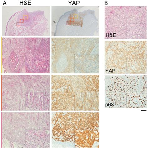 Yap Expression In The Hnscc Tumor Invasive Front Is Up Regulated A