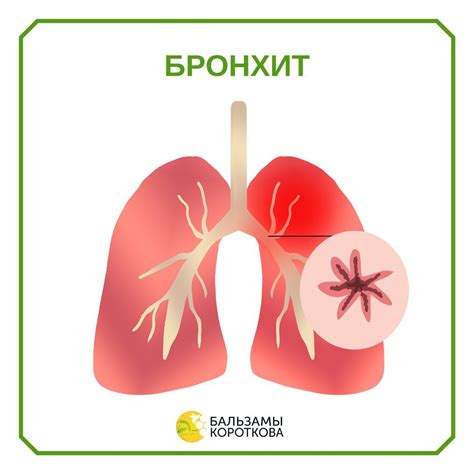 Бронхит