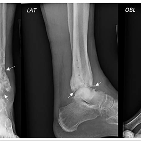 Anteroposterior Lateral And Oblique Radiographs Of The Left Ankle Download Scientific Diagram