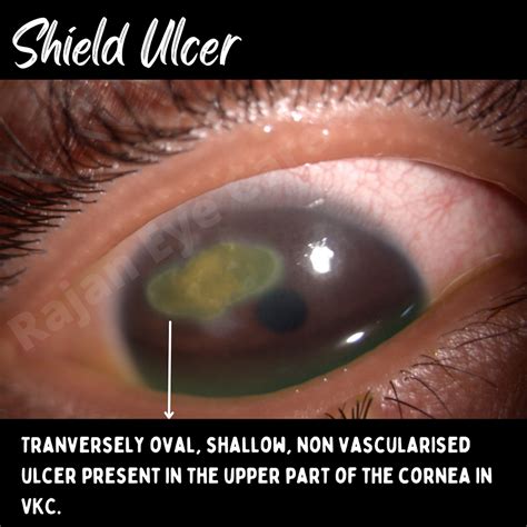 Shield Ulcer