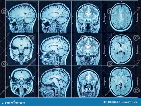 Closeup Of A Ct Scan With Brain Medical Science And Education Mri