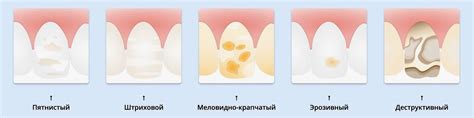 Что такое флюороз | Стоматологическая клиника «Дентал Эффект»