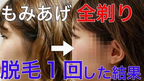 【もみあげ脱毛】もみあげを全剃りして1回脱毛をした結果 Youtube