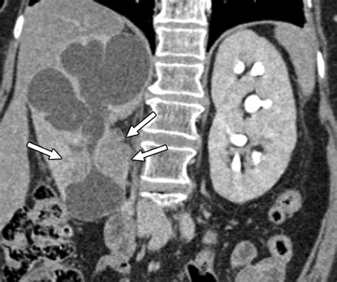 Transitional Cell Neoplasm Of The Upper Urinary Tract Evaluation With