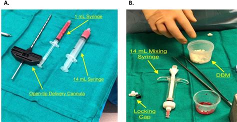 Pdf Intraosseous Bioplasty For A Subchondral Cyst In The Lateral