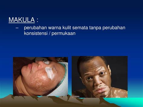 Ppt Makula Perubahan Warna Kulit Semata Tanpa Perubahan Konsistensi