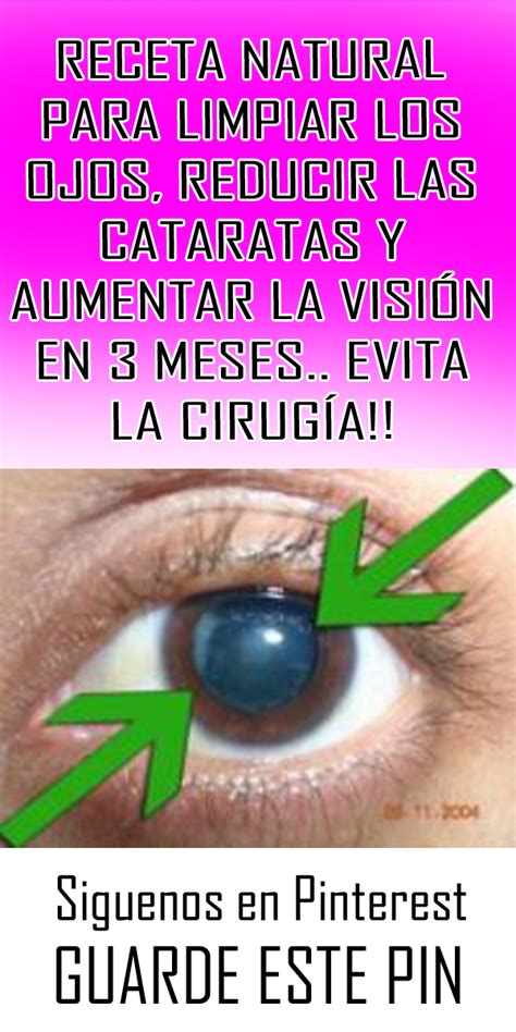 Receta Natural Para Limpiar Los Ojos Reducir Las Cataratas Y Aumentar