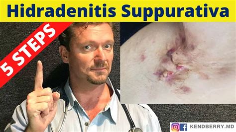 Hydradenitis Suppurativa 5 Steps To Reverse Hs