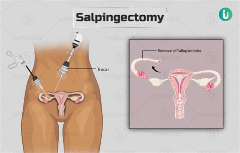 Salpingectomy Procedure Purpose Results Cost Price