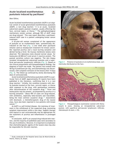 Pdf Acute Localized Exanthematous Pustulosis Induced By Paclitaxel