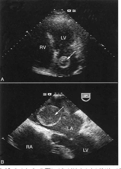 Left Atrial Mass Thrombus Mimicking Myxoma Semantic Scholar