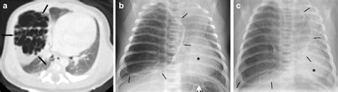 Pleuropulmonary blastoma. a Axial CT image through the thorax of a ...