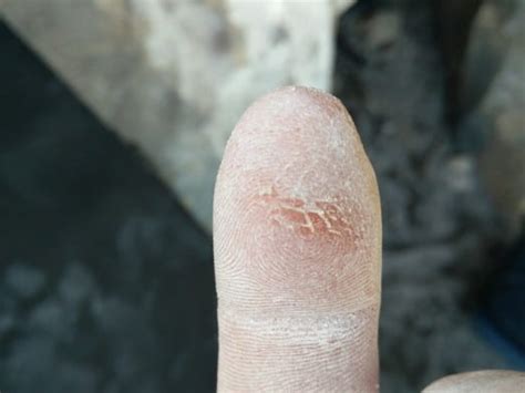 Black Hole In Skin That Looks Like Rocks