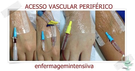 Enfermagem atualizada ACESSO VASCULAR PERIFÉRICO