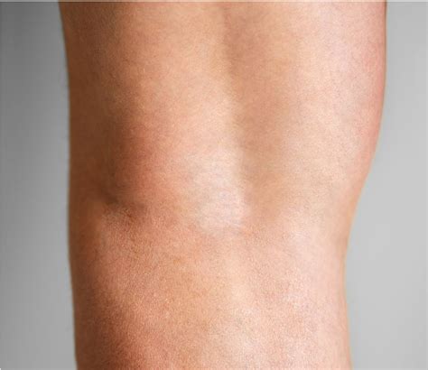 Evla Varicose Vein Treatment London Dermatology Clinic