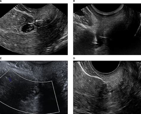 Conservative Management Of Cesarean Scar Pregnancy With Sonographically