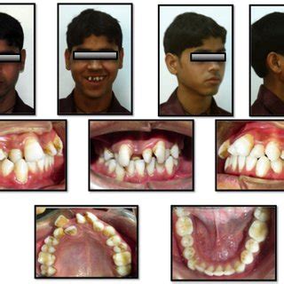 Radiografia Panor Mica Mostrando Acentuada Perda Ssea Horizontal