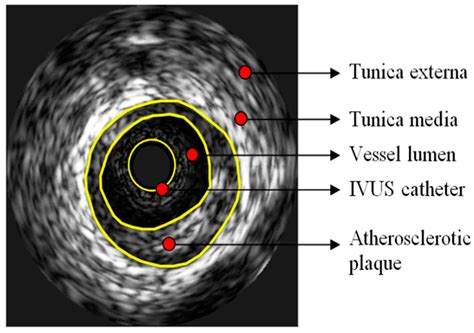 Jpm Free Full Text Personalized Assessment Of The Coronary