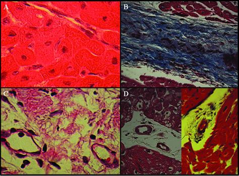 Histopathology of chronic myocardial infarction at four weeks after ...