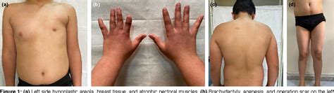 Figure 1 From A Rare Case Of Poland Syndrome Accompanied By Lower Extremity Anomaly Semantic