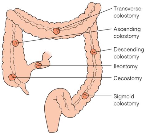 Pearsonvue Colorectal Cancer Flashcards Quizlet