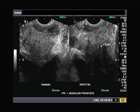 Ultrasound and Color Doppler videos: Prostate -transrectal ultrasound quiz