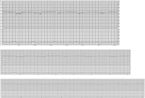 Figo Consensus Guidelines On Intrapartum Fetal Monitoring Cardiotocography Ayres‐de‐campos