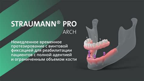 Straumann Pro Arch YouTube