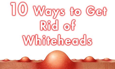 10 Ways to Get Rid of Whiteheads - Healthy Focus