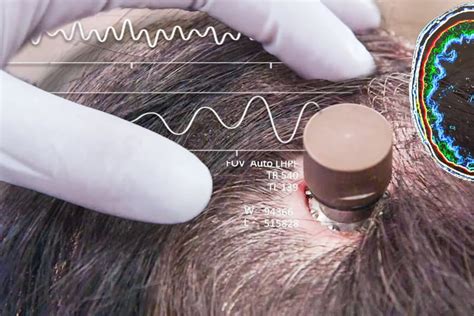 El Primer Paciente Con Un Chip Implantado En Su Cerebro Logr Mover