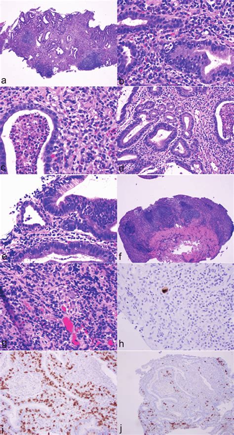 Histological Features Of Immunotherapy Associated Gastritis And