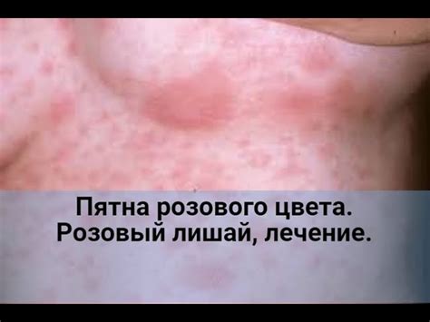 Как вылечить розовый лишай народными средствами