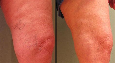 Spider Veins Before And After Photos Milwaukee Wi