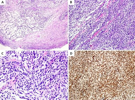 Histologic And Immunohistochemical Features A Histological