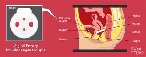 Is Pelvic Floor Repair Major Surgery Pelvic Health Guide Ryc®