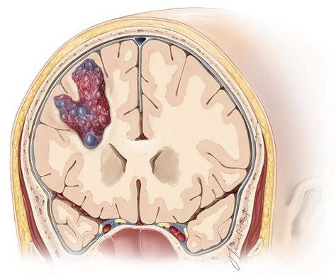 Cavernous Malformation Overview Aaron Cohen Gadol Md