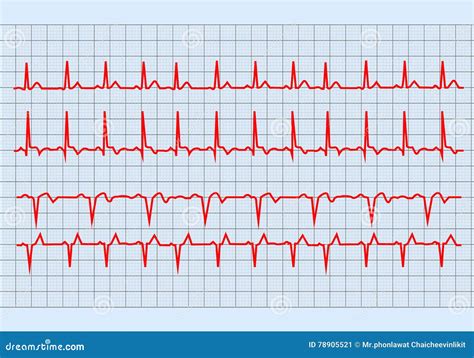 Ekg Diagramm vektor abbildung Illustration von überwachungsgerät