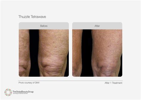 Thuzzle-Lipolysis Fat Reduction Before and After - Aesthetic Medical ...