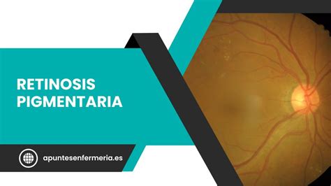 Retinosis pigmentaria causas síntomas diagnóstico y tratamiento