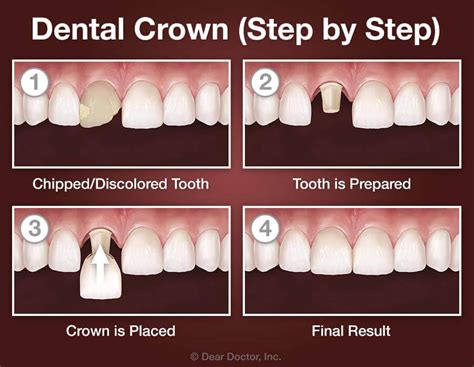 Crowns – Jourdain Dental Care | Calgary, Alberta | Family Dentist