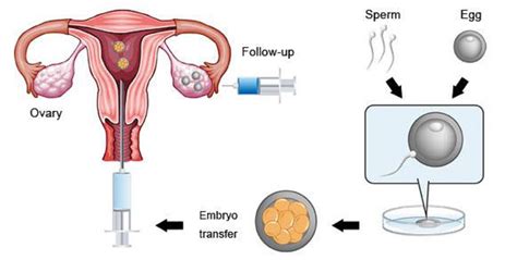 In Vitro Fertilisation IVF IVF American Hospital Tirana